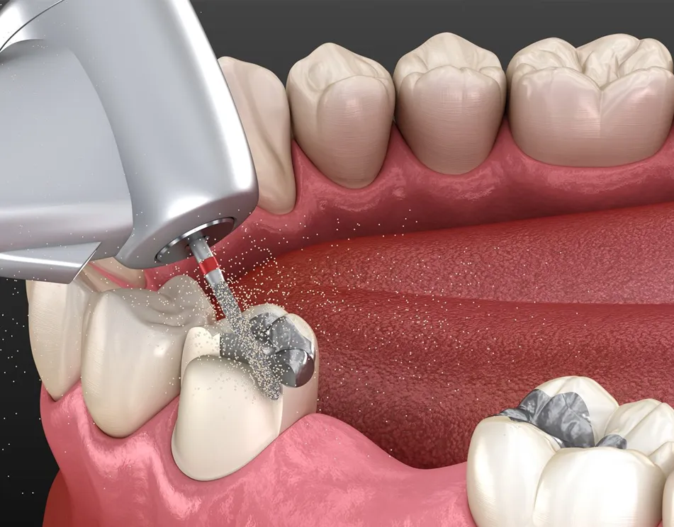 Mercury & Amalgam Removal