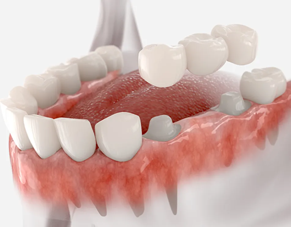 Biocompatible Crowns & Bridges