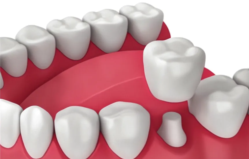 Zirconia Crowns