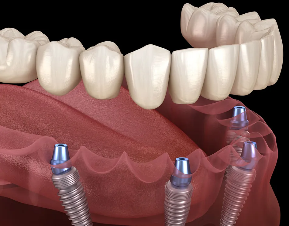 Full Mouth Reconstruction