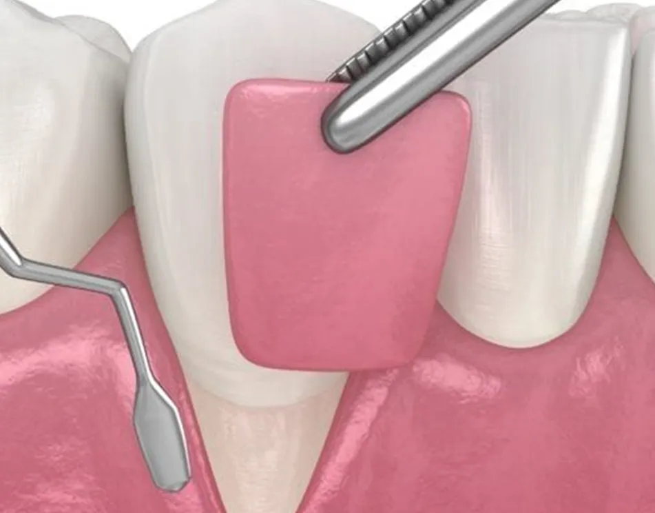 gum graft at biodent