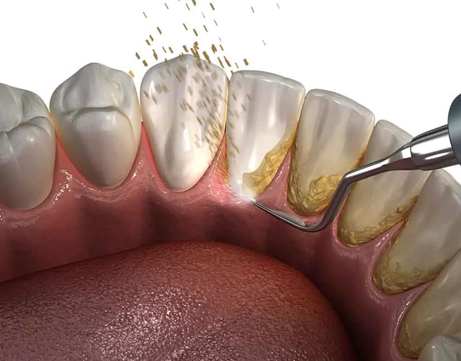 periodontics at biodent & Scaling & Root Planing