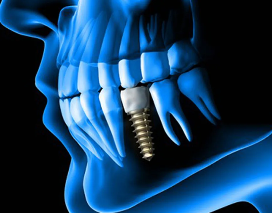 zirconia dental implants